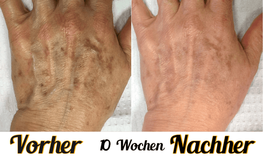 Lustra Band Classic - Hautverjüngende Lichttherapie für Hände