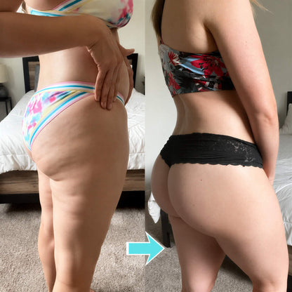 FormaTone - Passive Vibrotherapie gegen Cellulite