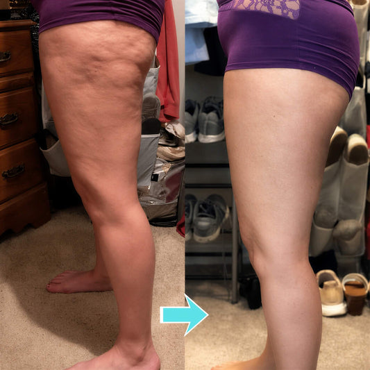FormaTone - Passive Vibrotherapie gegen Cellulite