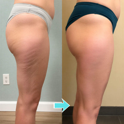 FormaTone - Passive Vibrotherapie gegen Cellulite