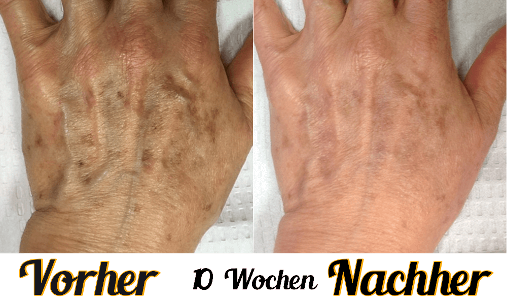 Lustra Band Classic - Hautverjüngende Lichttherapie für Hände