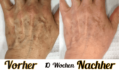 Lustra Band Classic - Hautverjüngende Lichttherapie für Hände