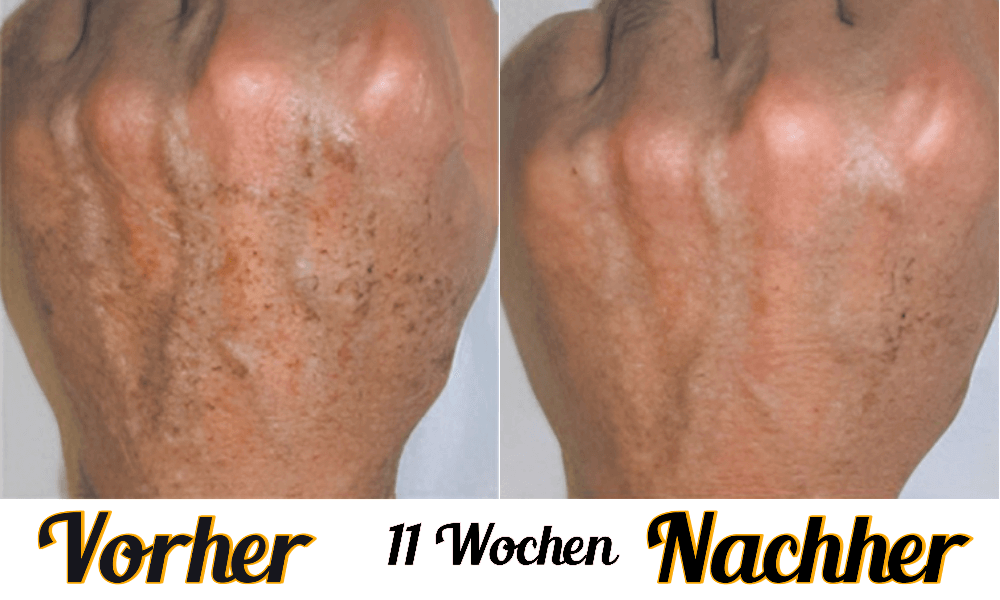 Lustra Band Classic - Hautverjüngende Lichttherapie für Hände