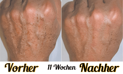 Lustra Band Classic - Hautverjüngende Lichttherapie für Hände