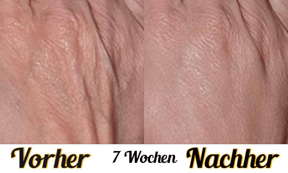 Lustra Band Classic - Hautverjüngende Lichttherapie für Hände