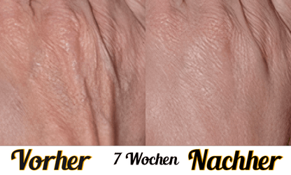 Lustra Band Classic - Hautverjüngende Lichttherapie für Hände