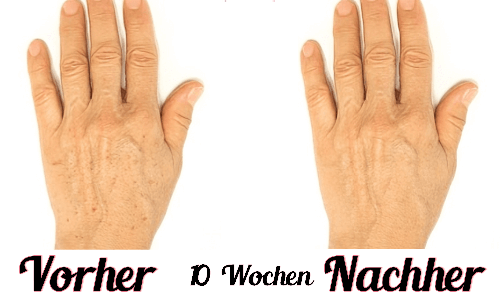 Lustra Hand Pro - Hautverjüngende Lichttherapie für Hände