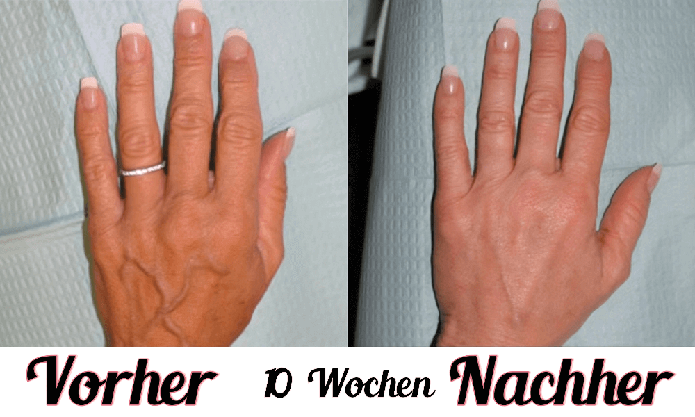 Lustra Hand Pro - Hautverjüngende Lichttherapie für Hände