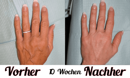 Lustra Hand Pro - Hautverjüngende Lichttherapie für Hände