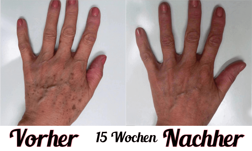 Lustra Hand Pro - Hautverjüngende Lichttherapie für Hände