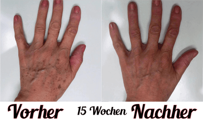 Lustra Hand Pro - Hautverjüngende Lichttherapie für Hände