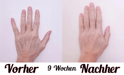 Lustra Hand Pro - Hautverjüngende Lichttherapie für Hände