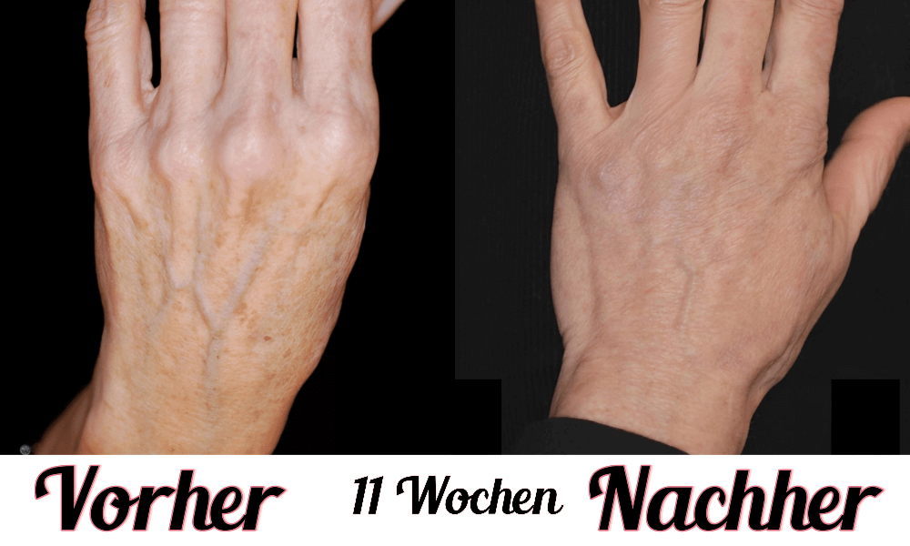 Lustra Hand Pro - Hautverjüngende Lichttherapie für Hände