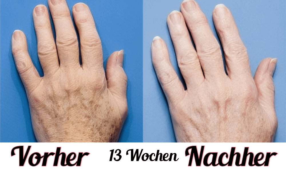 Lustra Hand Spa - Hautverjüngende Lichttherapie für Hände