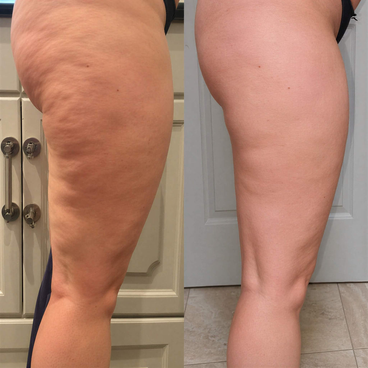Cellavex - Multimodales Massagegerät gegen Cellulite
