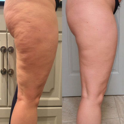 Cellavex - Multimodales Massagegerät gegen Cellulite