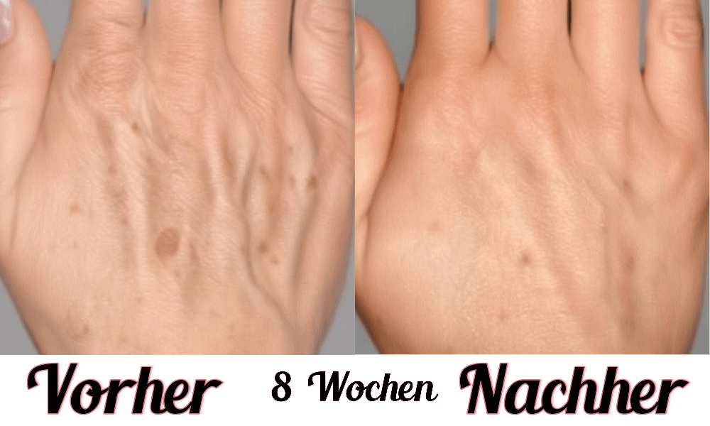 Lustra Band Go - Hautverjüngende Lichttherapie für Hände