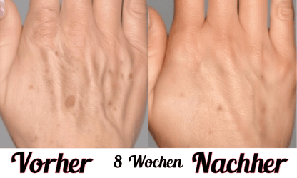 Lustra Band Go - Hautverjüngende Lichttherapie für Hände