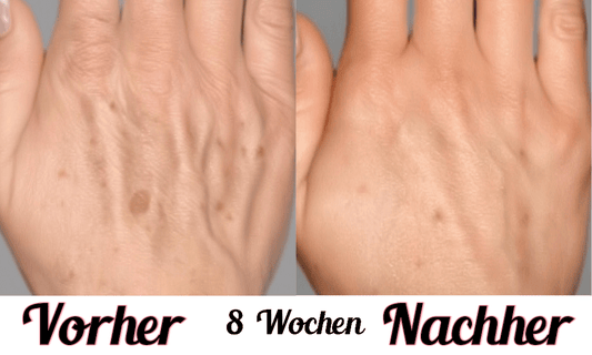 Lustra Band Go - Hautverjüngende Lichttherapie für Hände