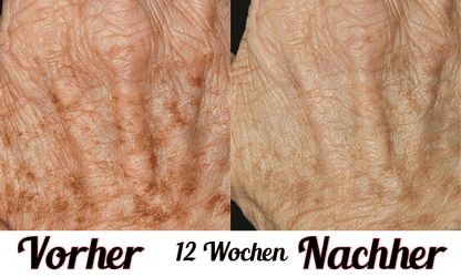 Lustra Band Go - Hautverjüngende Lichttherapie für Hände