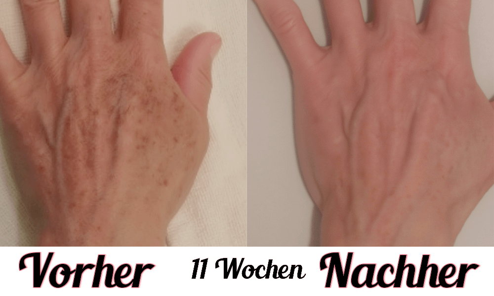 Lustra Band Go - Hautverjüngende Lichttherapie für Hände