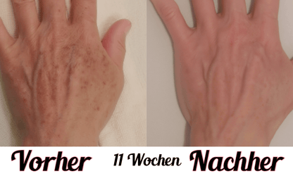 Lustra Band Go - Hautverjüngende Lichttherapie für Hände