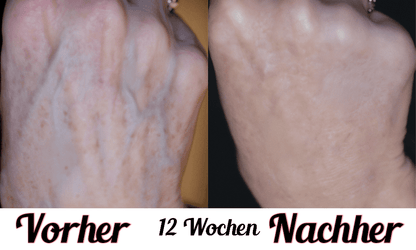 Lustra Band Go - Hautverjüngende Lichttherapie für Hände